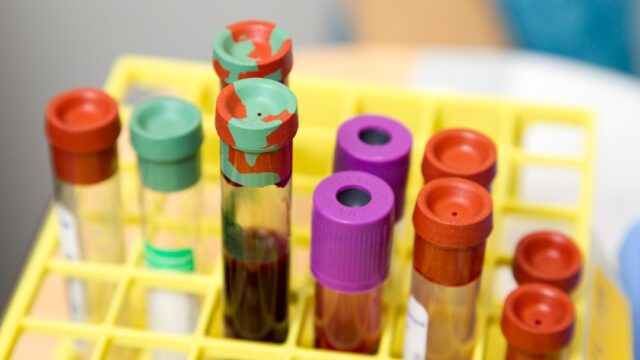 Blood test tubes in a medical laboratory representing understanding blood test results