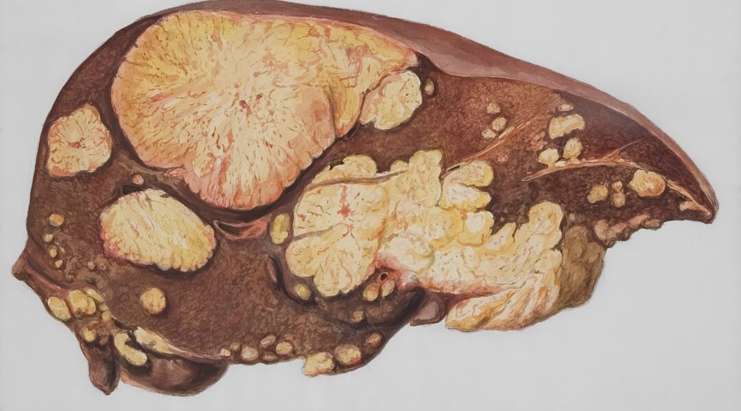 Visual comparison contrasting a healthy liver with one affected by fatty liver disease.