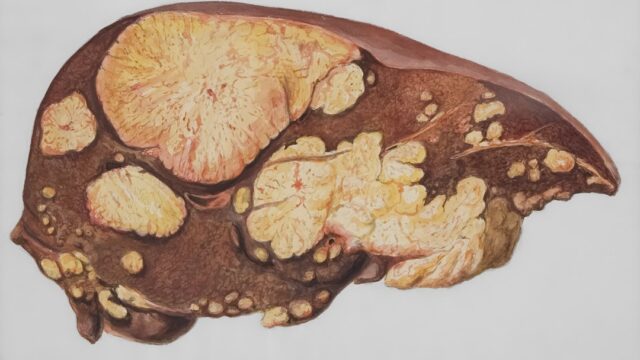 Visual comparison contrasting a healthy liver with one affected by fatty liver disease.